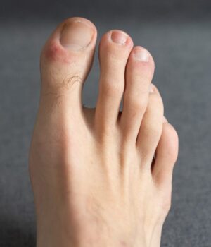 How To Treat A Dislocated Toe Dr Lance Silverman