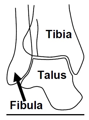 ankle fracture surgery