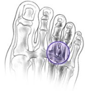 morton's neuroma treatment