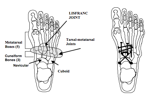 Midfoot Arthrodesis