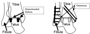 Osteoarticular Transplant