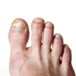 Toenail Infection