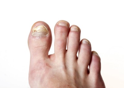 Toenail Infection