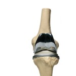 Knee Replacement