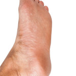 Flat Feet