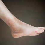 Ankle Sprain Roseville