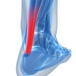 Achilles Tendinitis Minneapolis