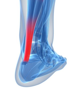 What Is Achilles Tendinitis? 