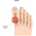 Gout Flare ups in uric acid Minneapolis