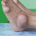 Gout and Afib