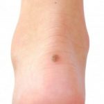 Skin Cancer Foot