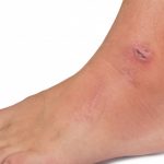 Diabetic Foot ulcers minnesota