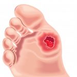 Diabetic Foot Ulcer Treatment minnesota