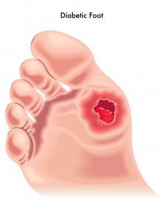 Attitude May Affect Diabetic Foot Ulcer Survival | Foot Surgery in St. Paul