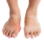 Gout Guidelines Minnesota