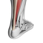 achilles tendinitis