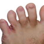 athlete's foot care