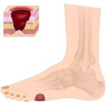 foot ulcer