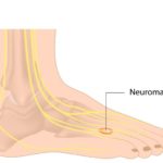 neuroma treatment