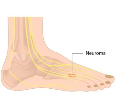 neuroma treatment