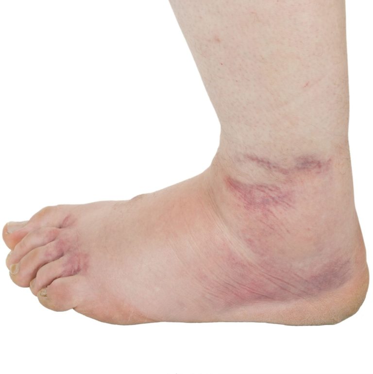 Ankle Swelling Archives Silverman Ankle And Foot Edina Orthopedic Surgeon 2622