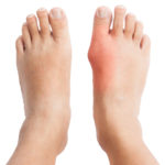 gout diet