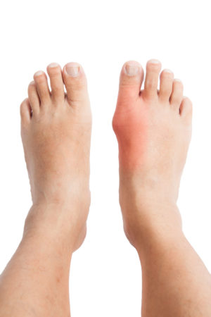 Why Gout Isn't Always Easy To Treat | Dr. Lance Silverman