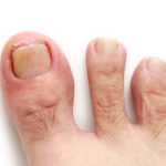 ingrown toenail shoes