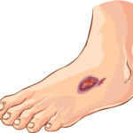 diabetic foot ulcers