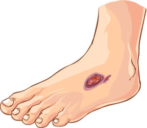 diabetic foot ulcers