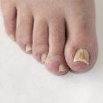 toenail fungus