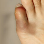 toe sprain