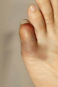 how do i know if my toe is broken