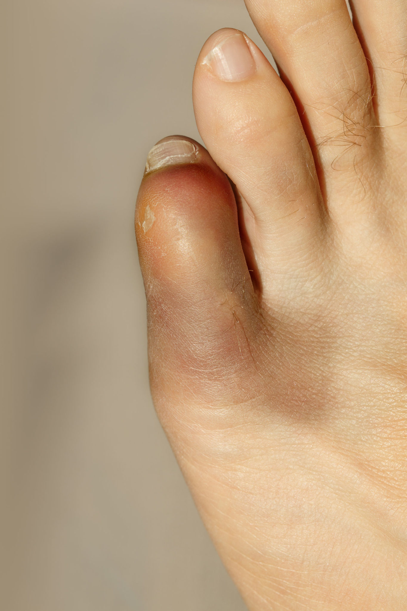 How To Treat A Broken Pinky Toe | Foot Doctor In Chanhassen