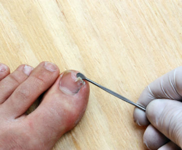 What To Do If Your Toenail Is Falling Off | Roseville Toe Doctor
