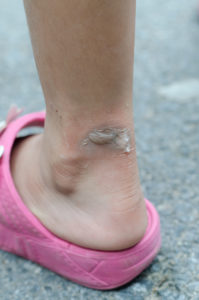 ankle ulcer