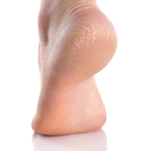 The Causes and Treatment Options For Cracked Heels | Dr. Lance Silverman