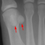 sesamoid bone