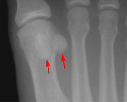 sesamoid bone