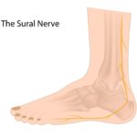 sural nerve pain