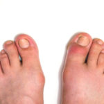 covid feet symptoms