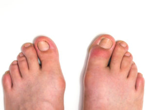 covid feet symptoms