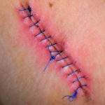 stitches