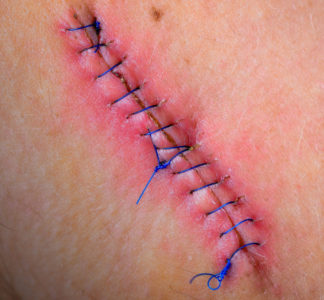 stitches