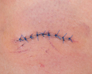 suture color changing