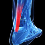 achilles tendonitis