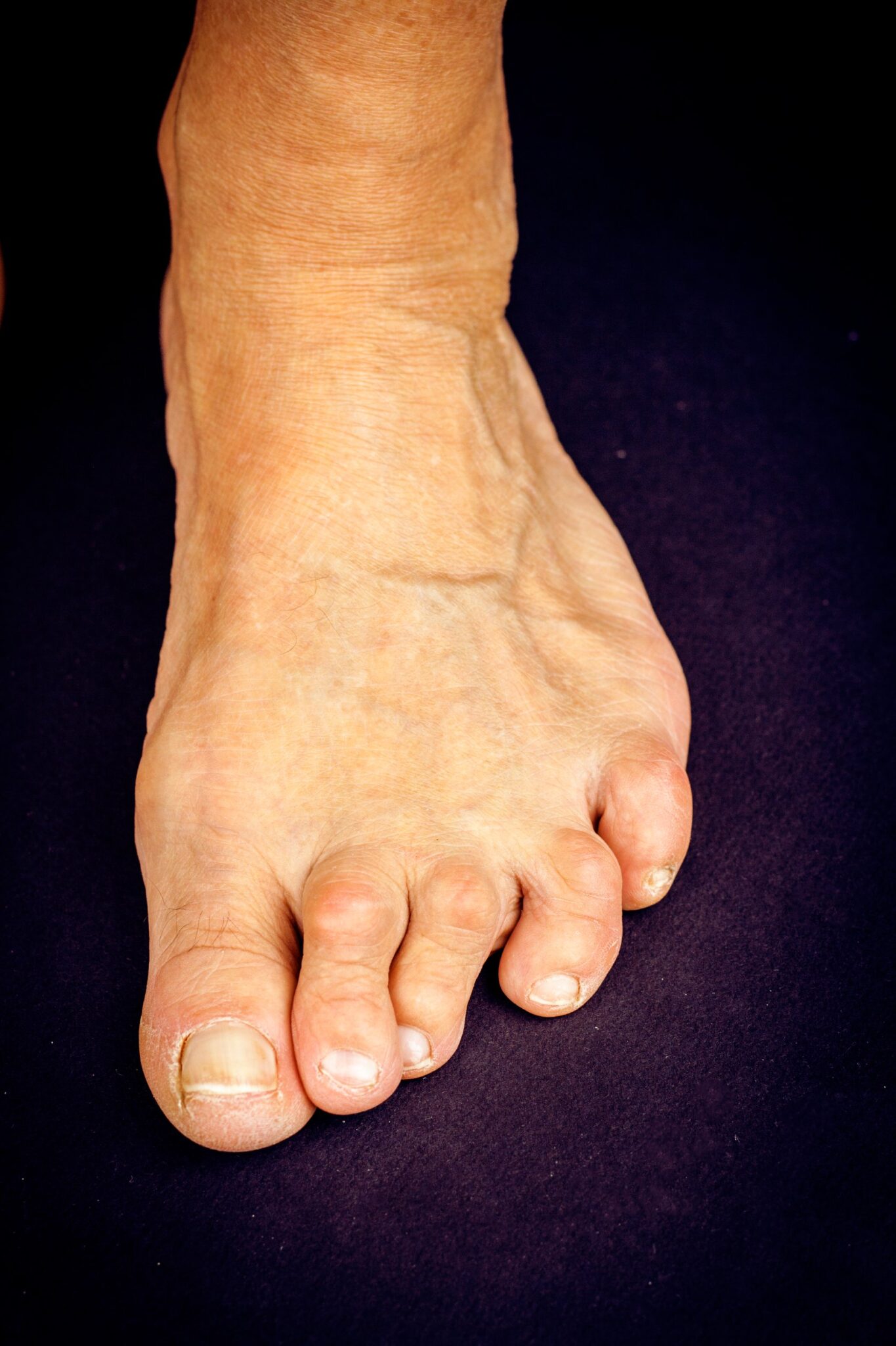 How To Treat Overlapping Toes | Dr. Lance Silverman