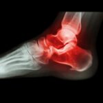 ankle arthritis