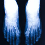 bone density scan